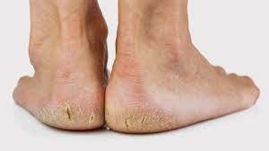 Homeopathy Medicine for Cracked Heels